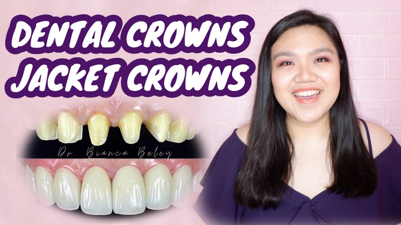 DENTAL CROWNS or JACKET CROWNS 🦷👑 | Pinoy Dentist Explained | Dr. Bianca Beley