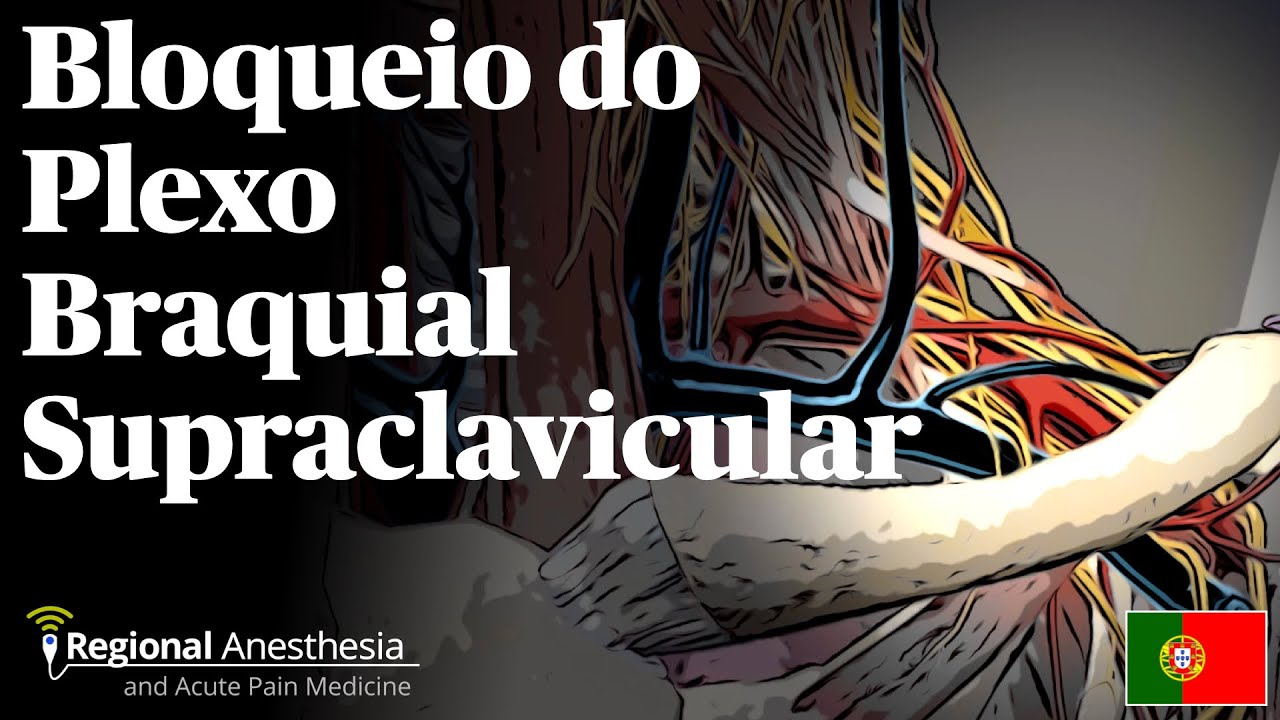 Bloqueio do Plexo Braquial Supraclavicular