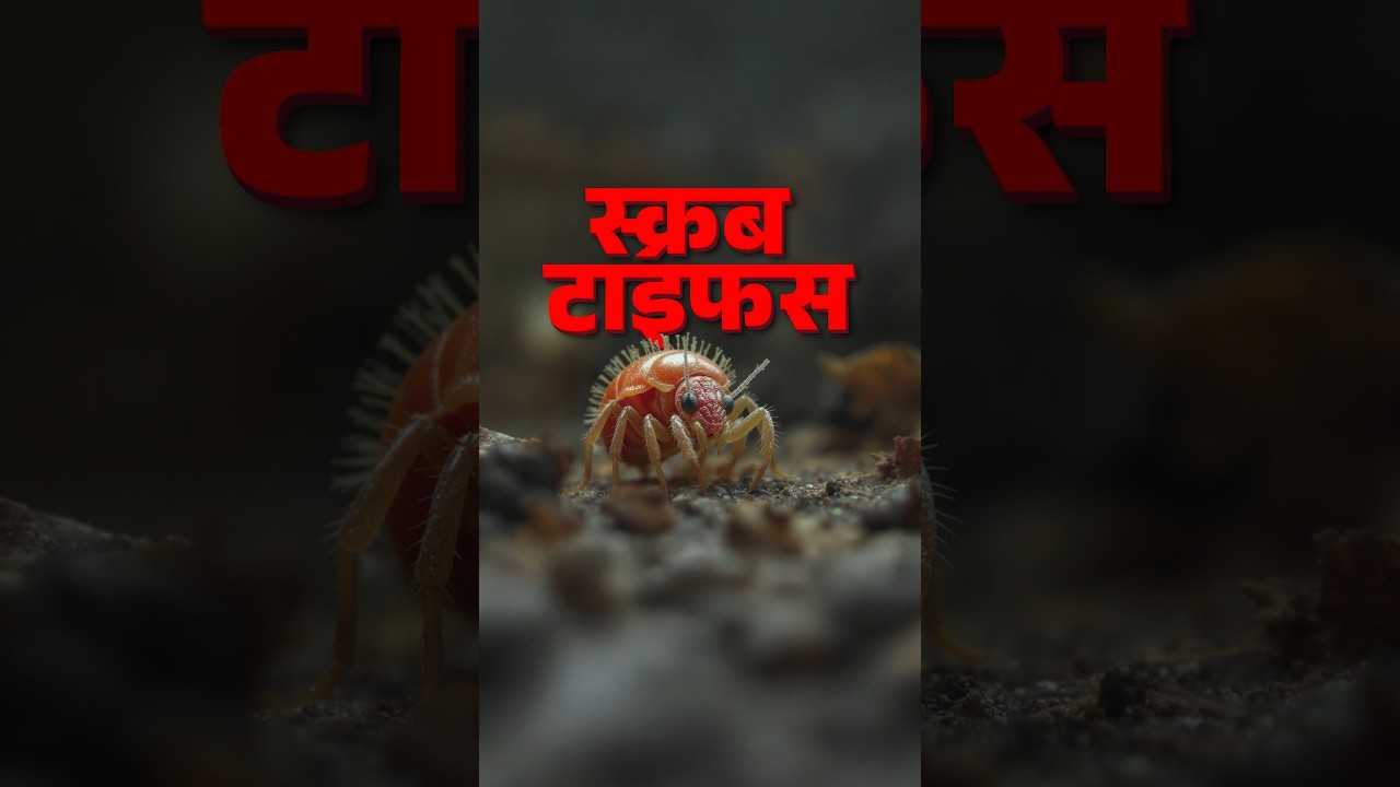 Scrub Typhus: A Seasonal Bacterial Infection in Himachal