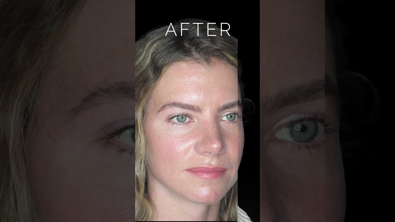 Before & After Rhinoplasty Surgery: Bulbous Tip & Wide Nose #nosejobbeforeandafter #nosejobs