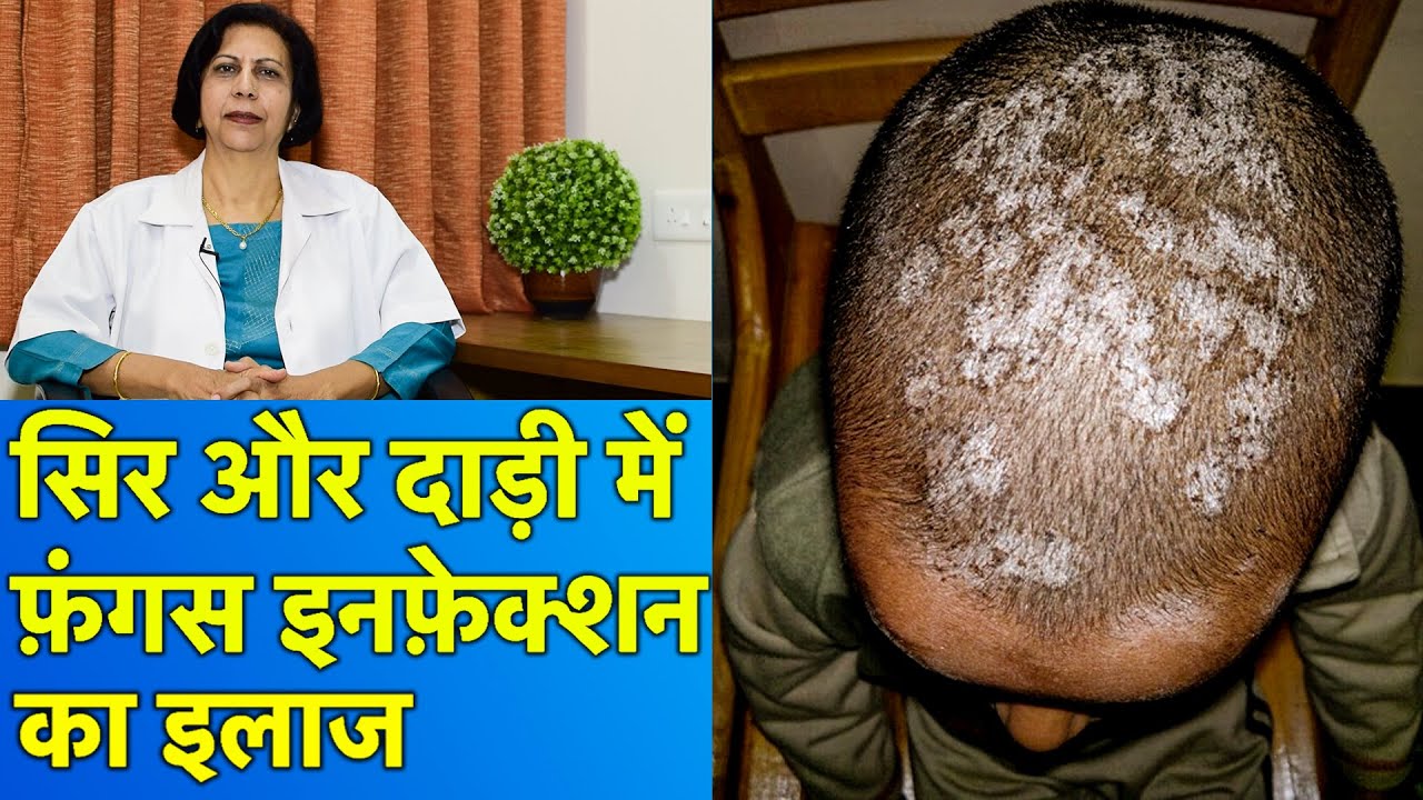 सिर और दाड़ी के फ़ंगस इनफ़ेक्शन का इलाज || Treatment of Fungal Infections In Beard & Scalp