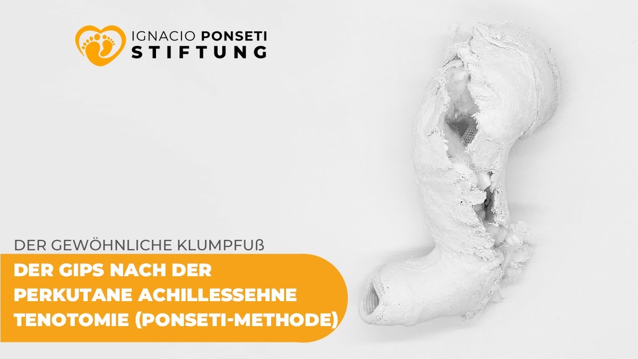 Der Gips nach der perkutane Achillessehne Tenotomie (Ponseti-Methode)