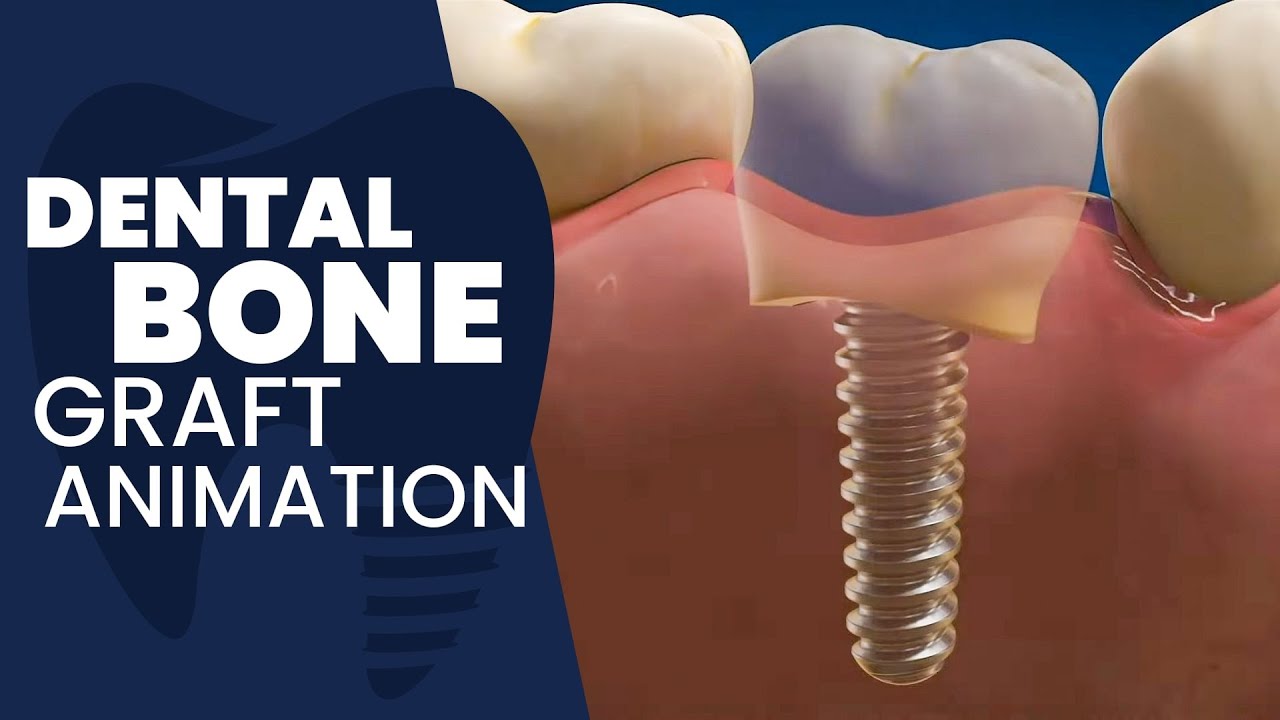 Dental Bone Graft Animation