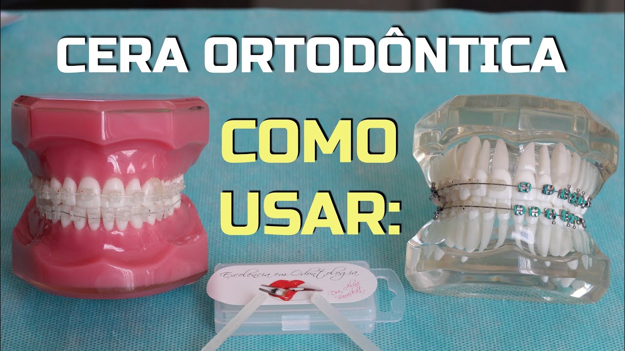 #74 COMO USAR: Cera ortodôntica