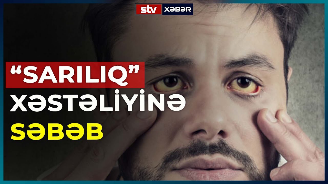 SARILIQ XƏSTƏLİYİNƏ SƏBƏB OLAN AMİLLƏR - STV XƏBƏR