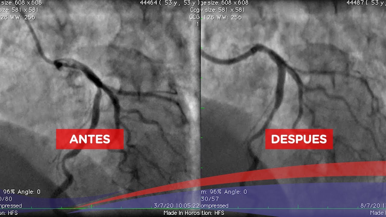 Angioplastia coronaria a bifurcación en arteria descendente anterior y ramo diagonal