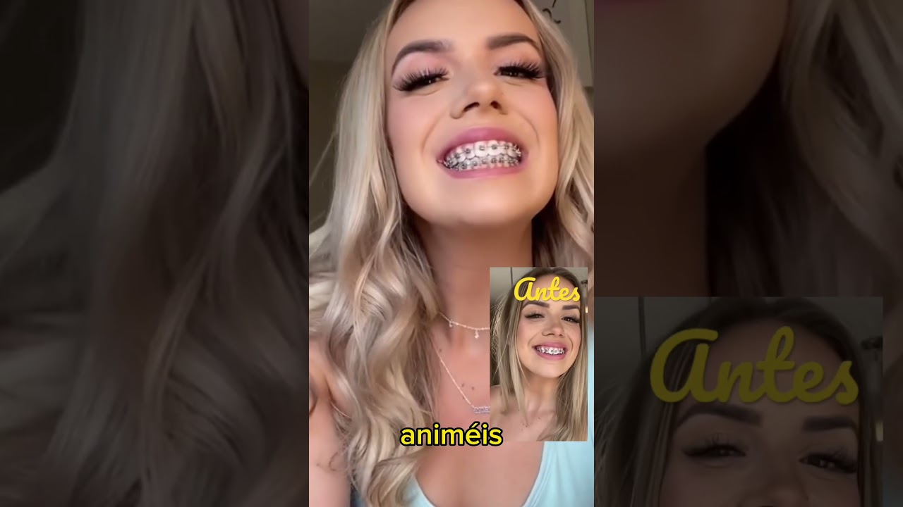 &iexcl;Incre&iacute;ble antes y despu&eacute;s de usar brackets!