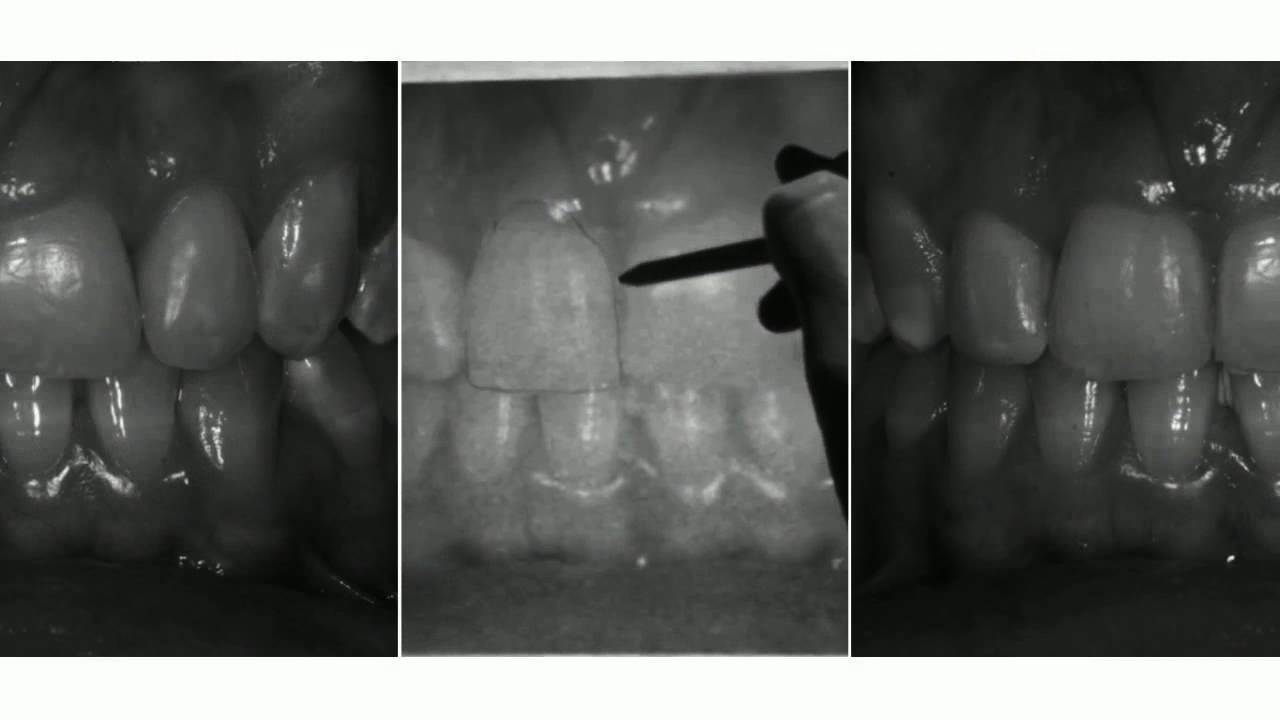 Gum Lift HD
