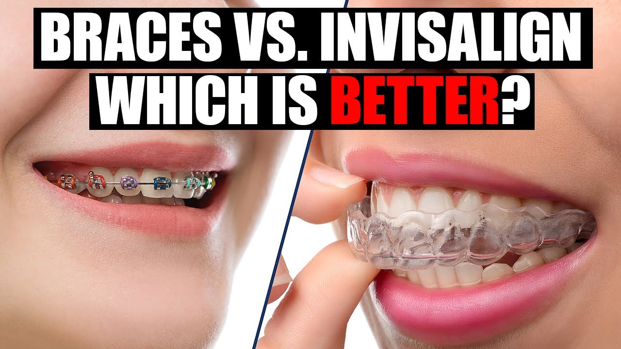 Braces Vs. Invisalign - Which Is Better? - Orthodontic Specialist Advice
