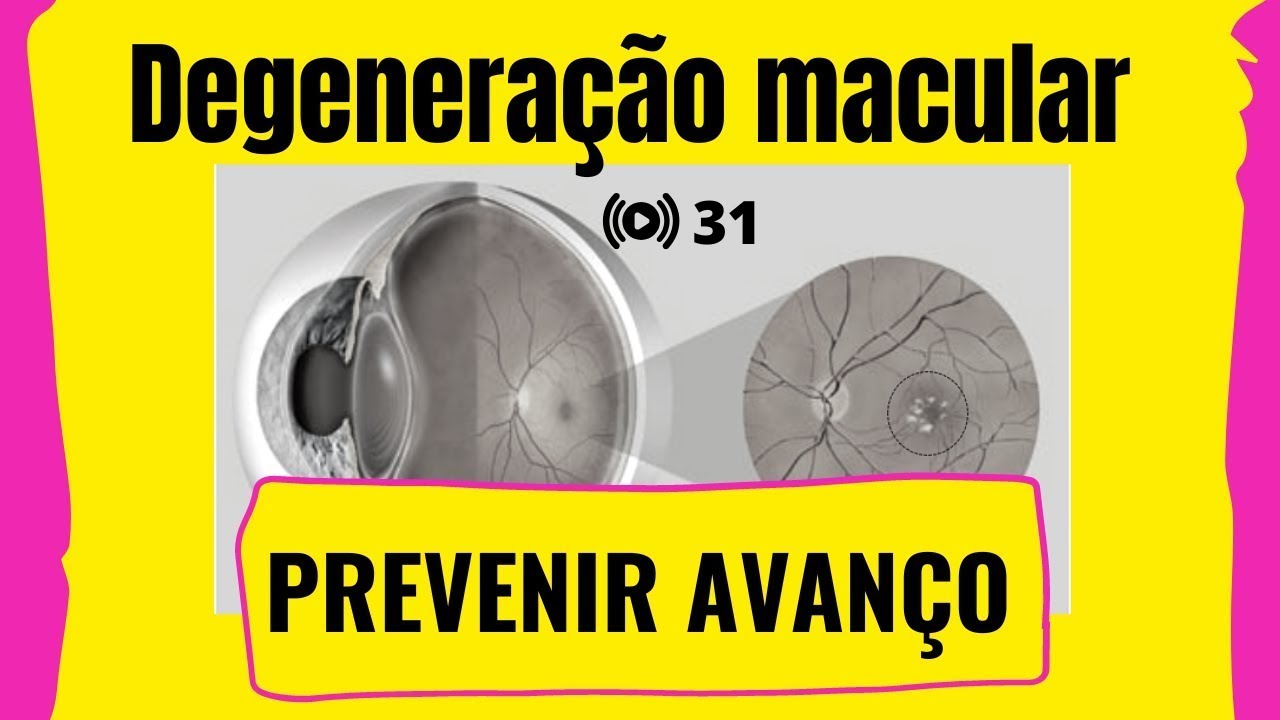 #31 Degeneração Macular | Prevenir avanço | Exercícios visuais