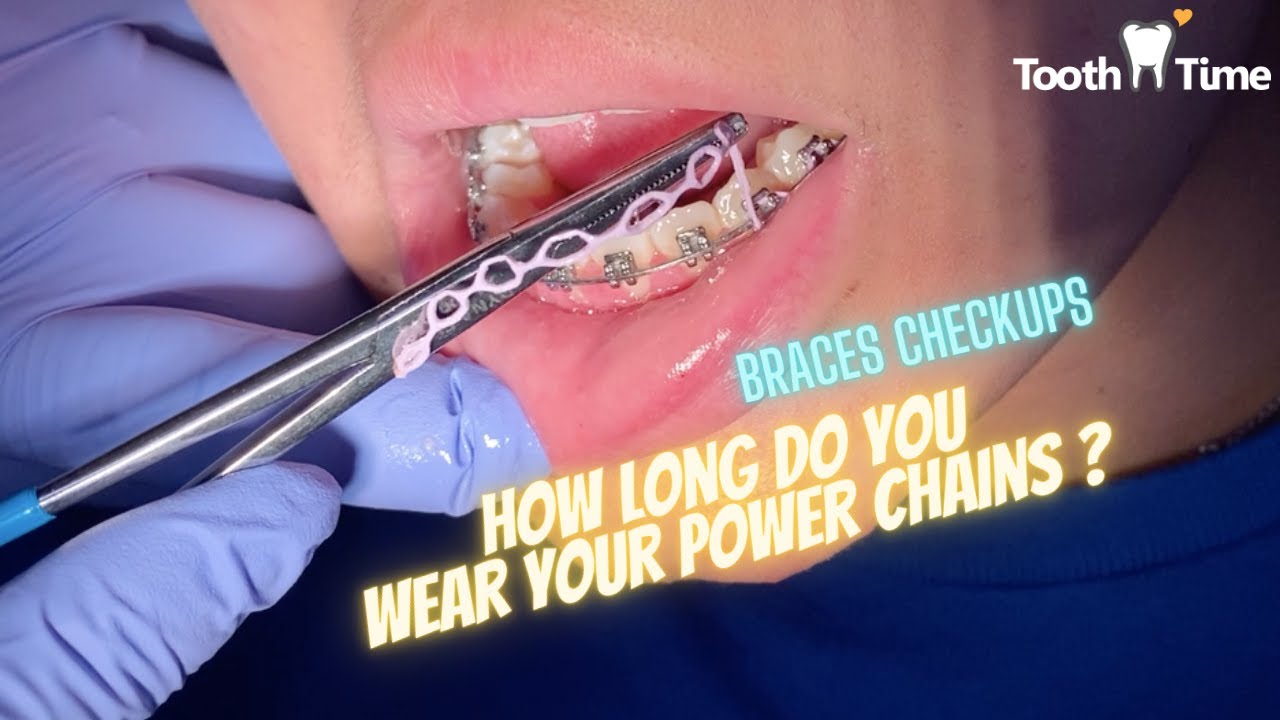 How long do you wear power chains - Braces Checkups - Tooth Time Family Dentistry New Braunfels