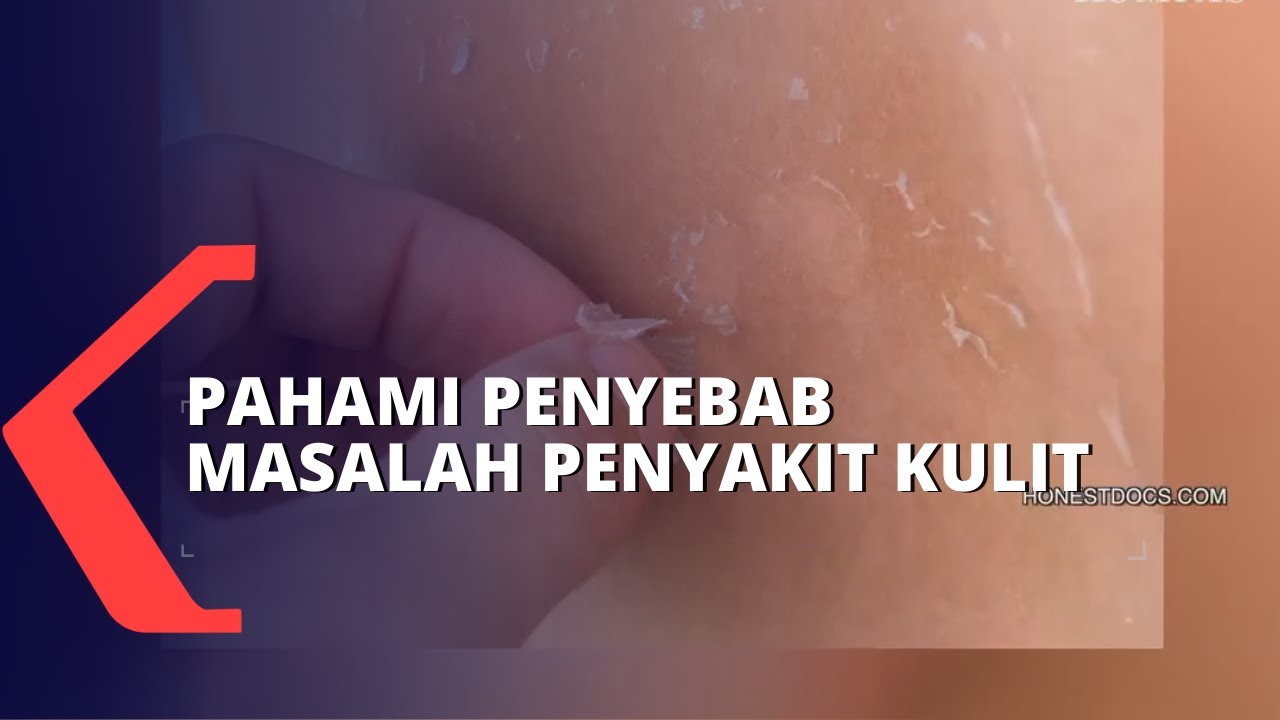 Ketahui Penyebab Penyakit Kulit dan Cara Mengatasinya