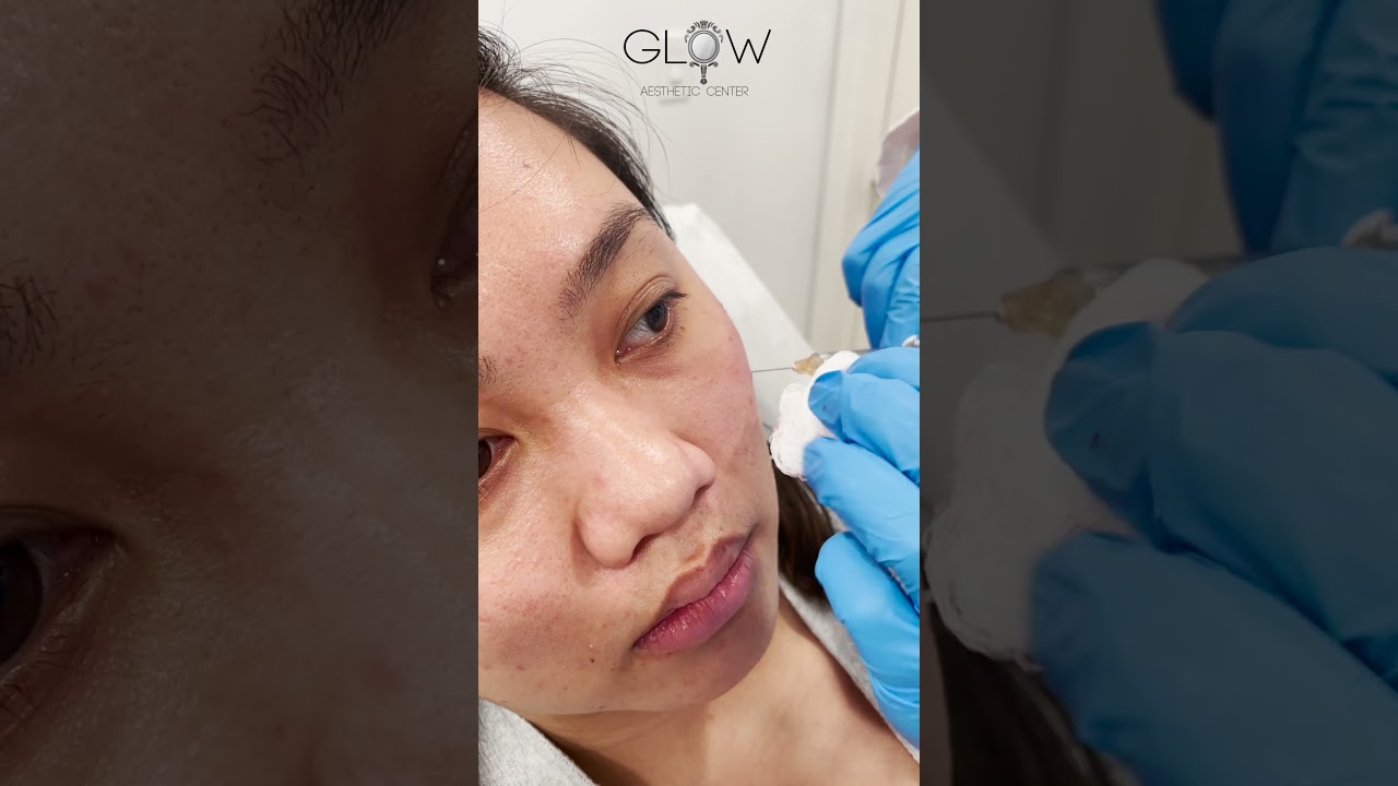 Under Eye Filler Treatment with Cannula - Glow Aesthetic Center