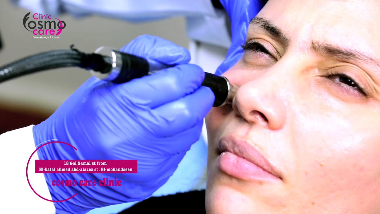 احدث تقنية لتنظيف العميق للبشرة والتقشير الماسي ف جلسة واحدة بالهيدرافشيل - hydra facial
