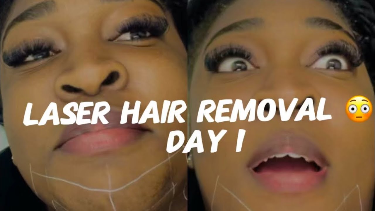 Getting Laser Treatment: A Day in My Life🫣