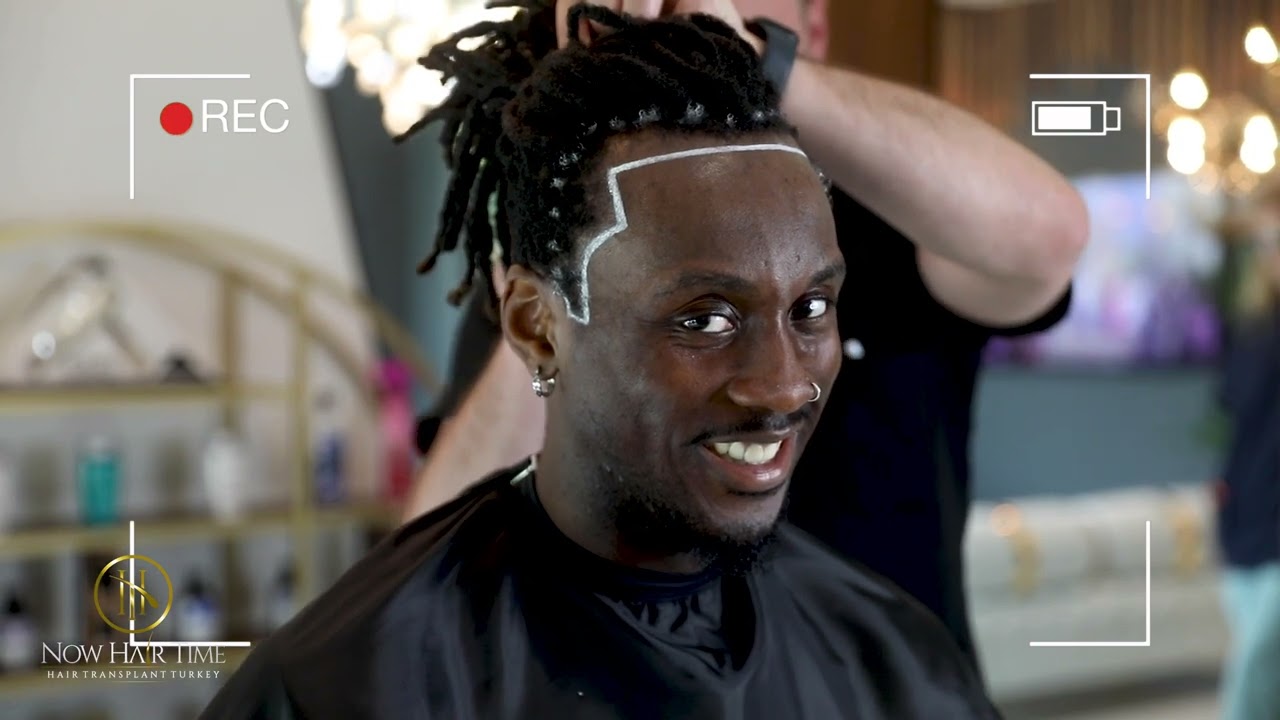 Hair Transplant Journey!         - Afro Hair