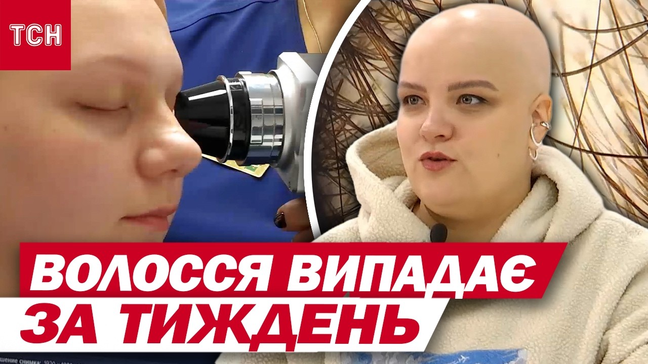 УКРАЇНЦІ різної СТАТІ і ВІКУ втрачають ВСЕ ВОЛОССЯ за ТИЖДЕНЬ! ВІЙНА СПРОВОКУВАЛА НЕДУГУ!