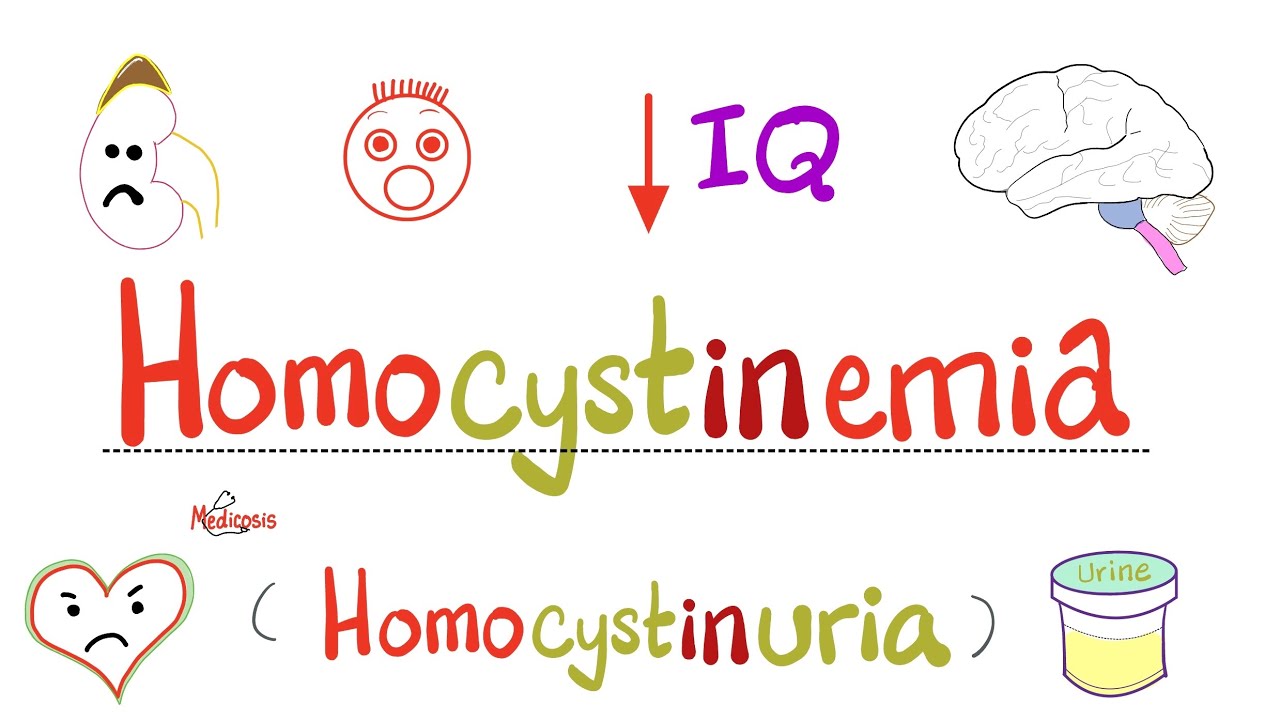 Homocystinemia (Homocystinuria) - Causes, Symptoms, Diagnosis, Treatment - Biochemistry & Genetics