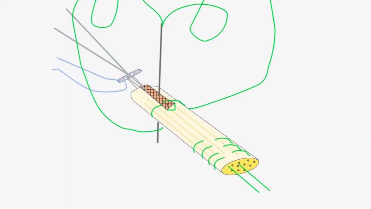 All soft tissue quadriceps tendon graft preparation with the Fiber tag Tight Rope device!