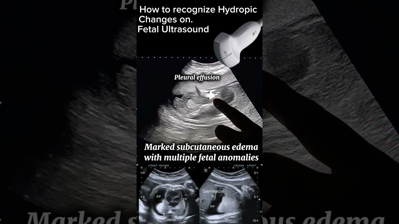 How to recognize Hydropic Changes on Fetal Ultrasound #ultrasoundfindings#health @Dr.SaimaKhan