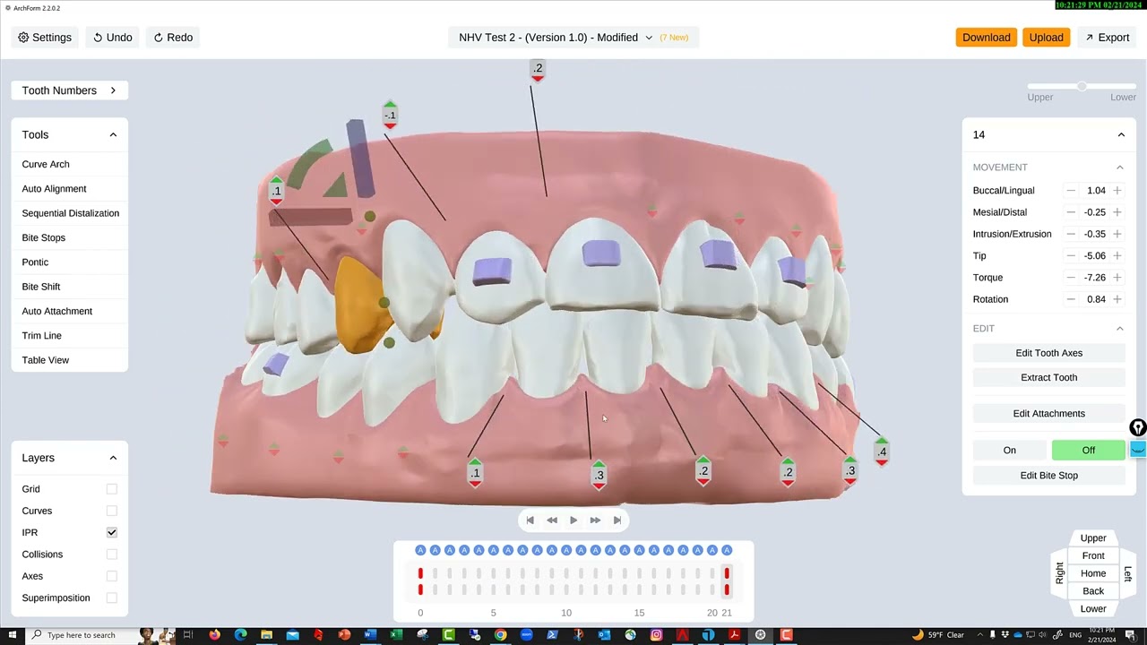 Different software to align teeth with orthodontic aligners