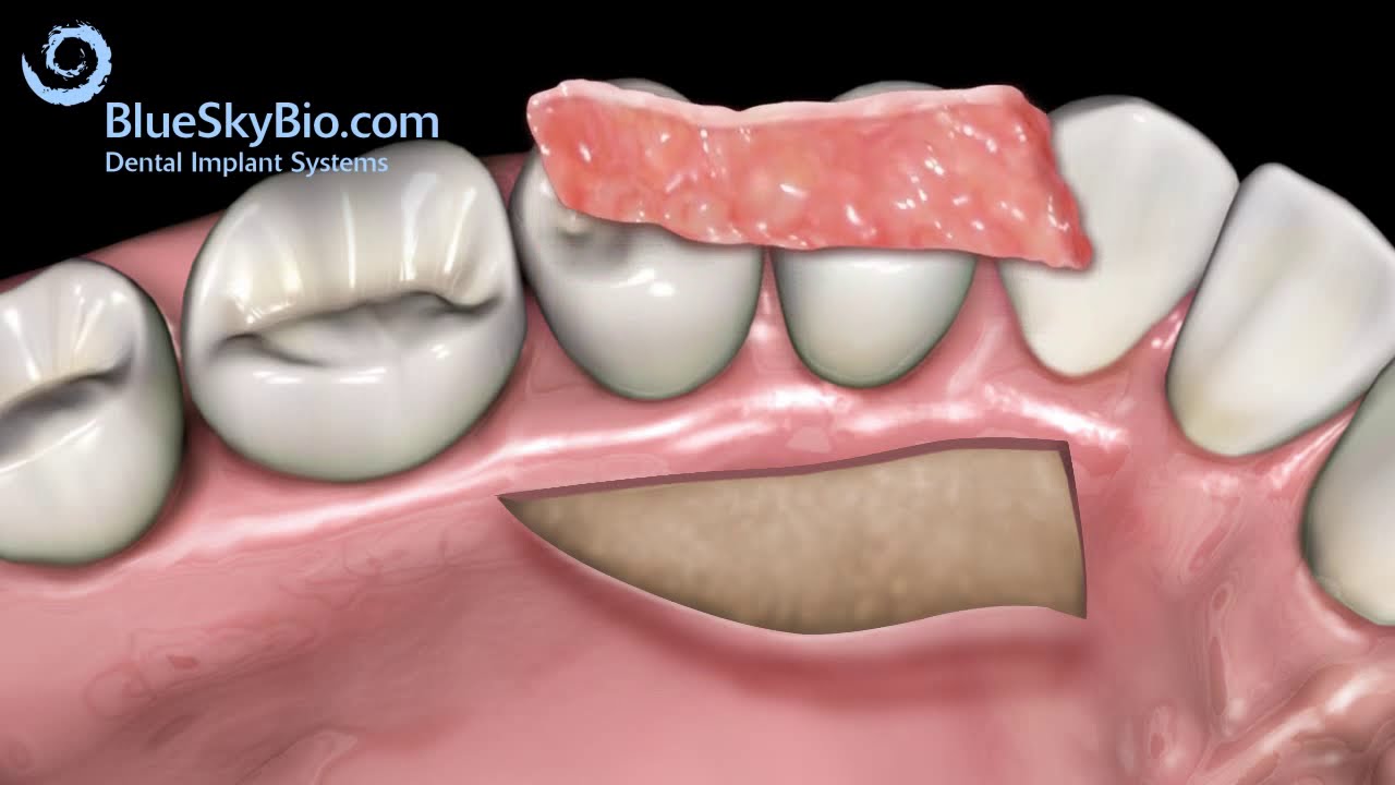 What is a gum-graft? Understanding Gum Graft Surgery: Advance Dental Implant and TMJ Center