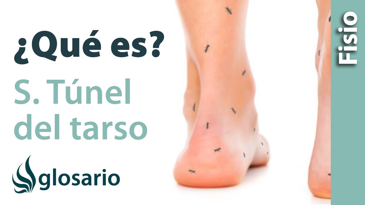 SÍNDROME DEL TÚNEL DEL TARSO | ¿Qué es?