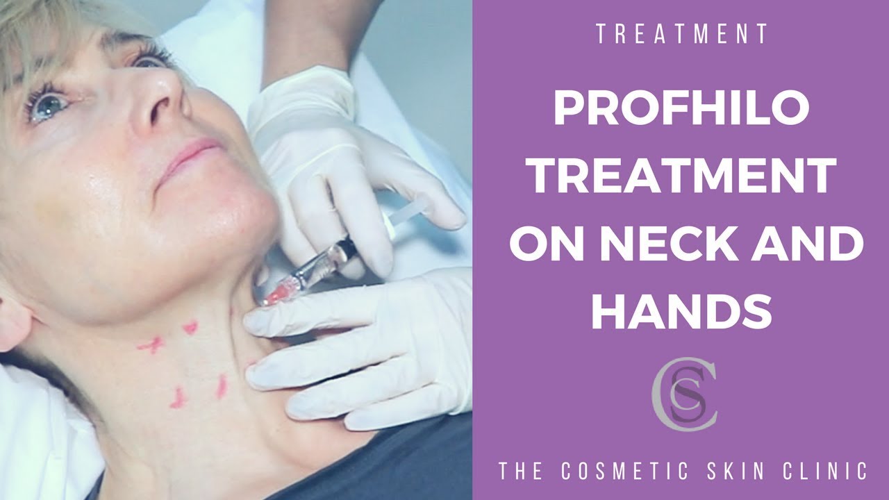Profhilo Treatment On Neck and Hands | The Cosmetic Skin Clinic