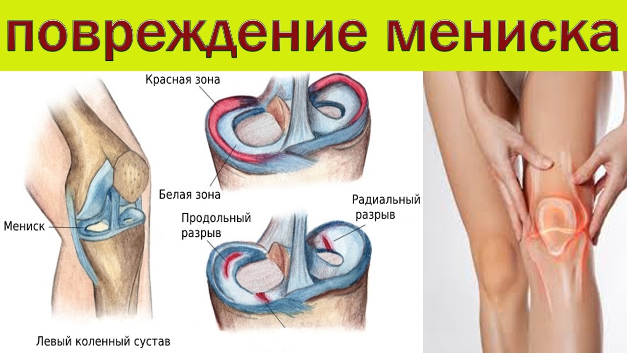 Чем опасно повреждение мениска..