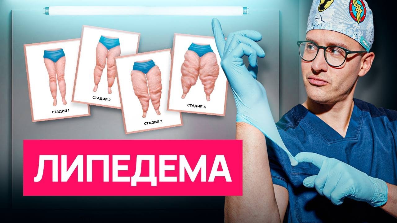 Почему не получается похудеть? Этим пациентам поможет только липосакция!