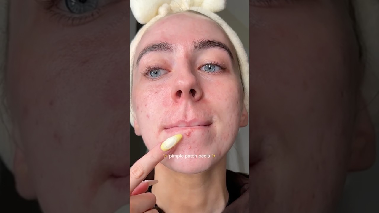 Pimple Patch Peel ✨