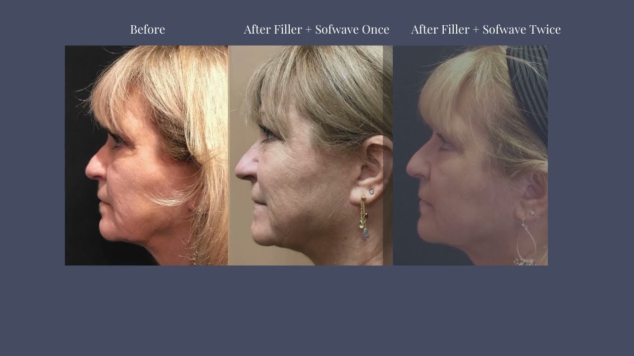 #Sofwave Before & After Photos: Results You Can Achieve with a #NonSurgicalFacelift