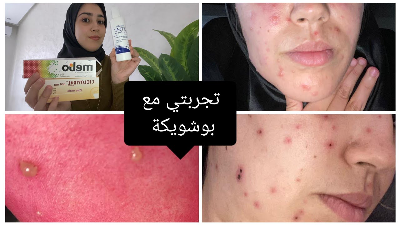 تجربتي مع بوشويكة عند الكبار 😑 الادوية اللي استعملت باش نداوي #بوشويكة  😍