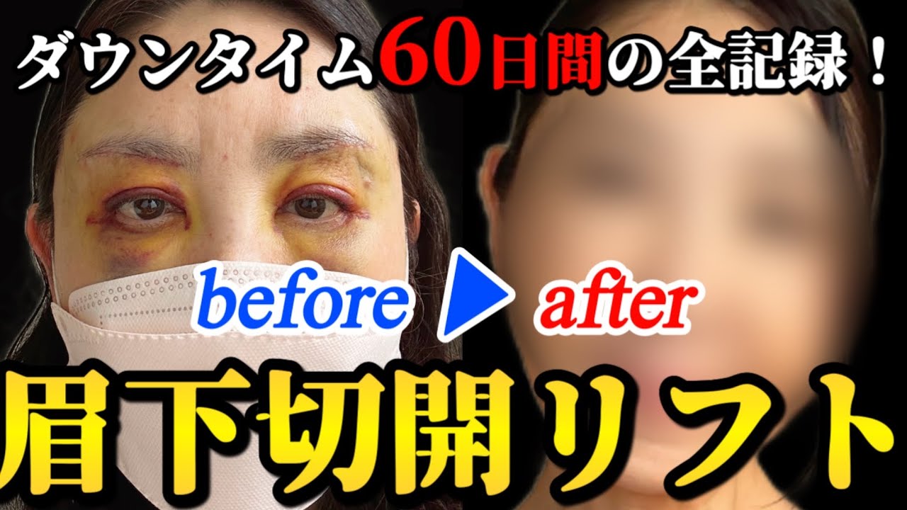 眉下切開の真実｜60日間のダウンタイムを毎日追いました