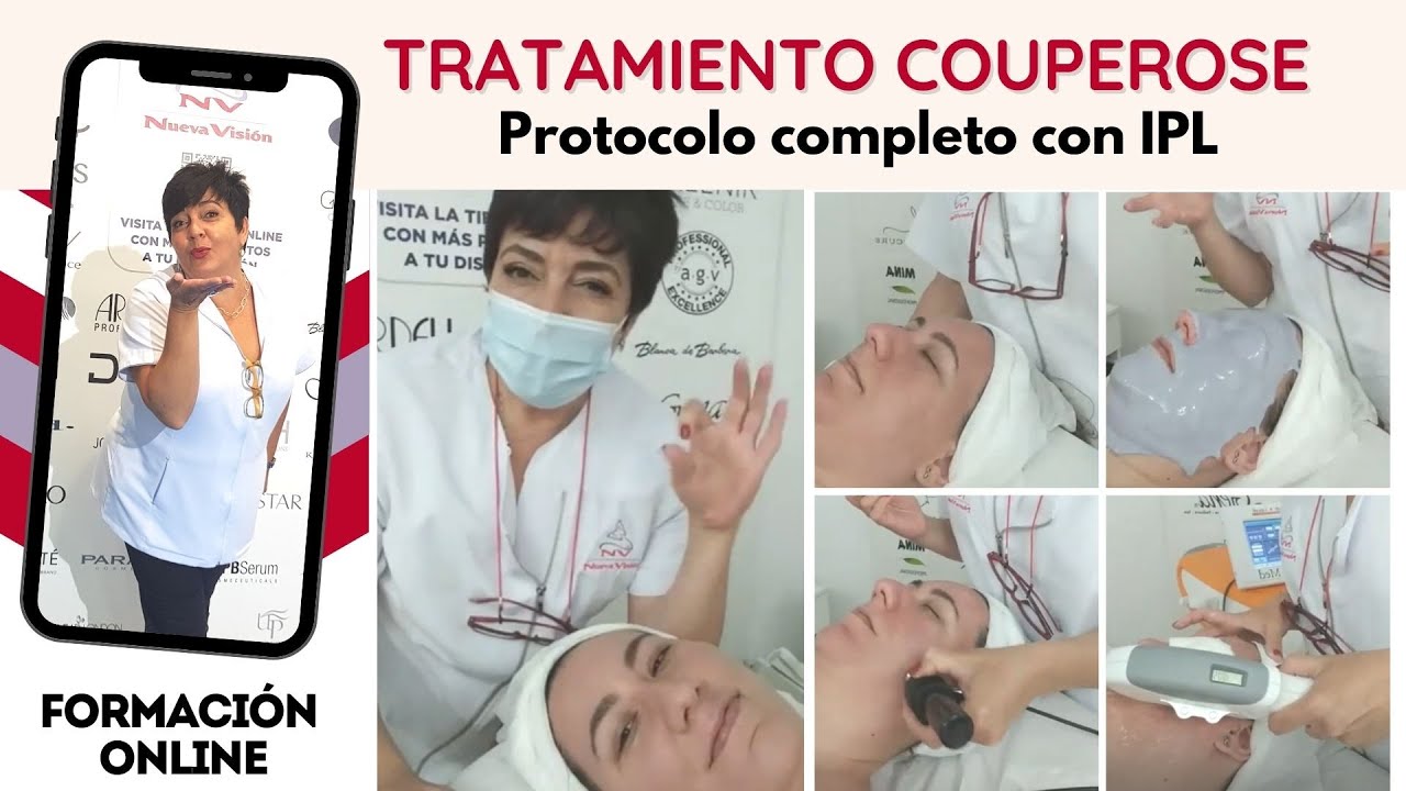 Protocolo de tratamiento de piel con couperose (reactiva) con IPL