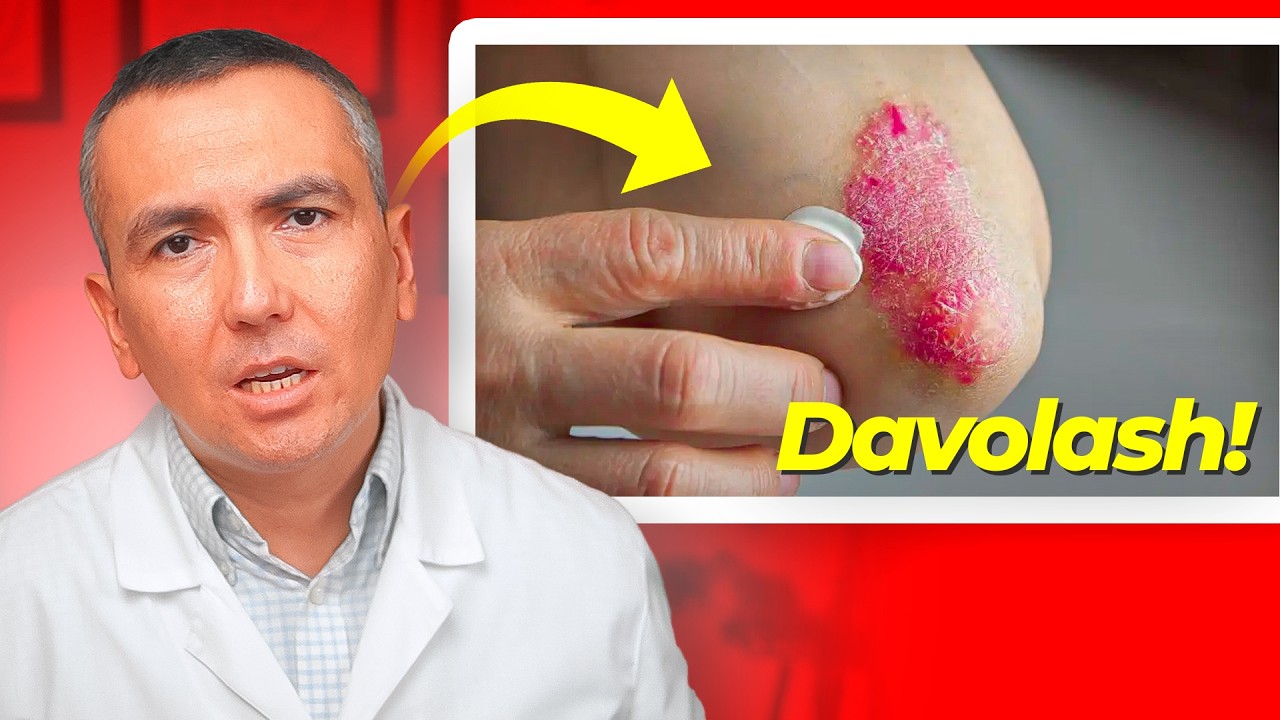 Psoriaz qanday davolanadi? Eng muhim ma'lumotlar!