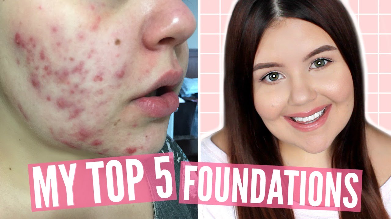 BEST FOUNDATIONS FOR ACNE PART 2 | My Updated Top 5 Foundations