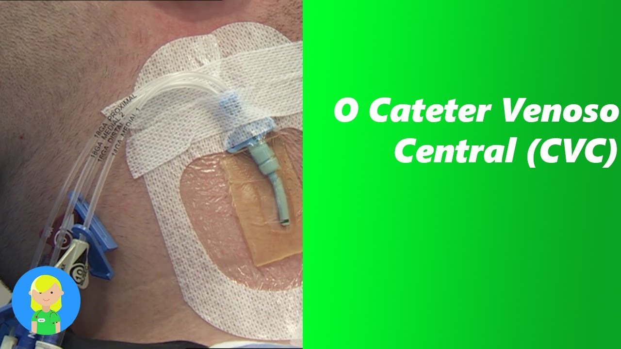 O Cateter Venoso Central (CVC)
