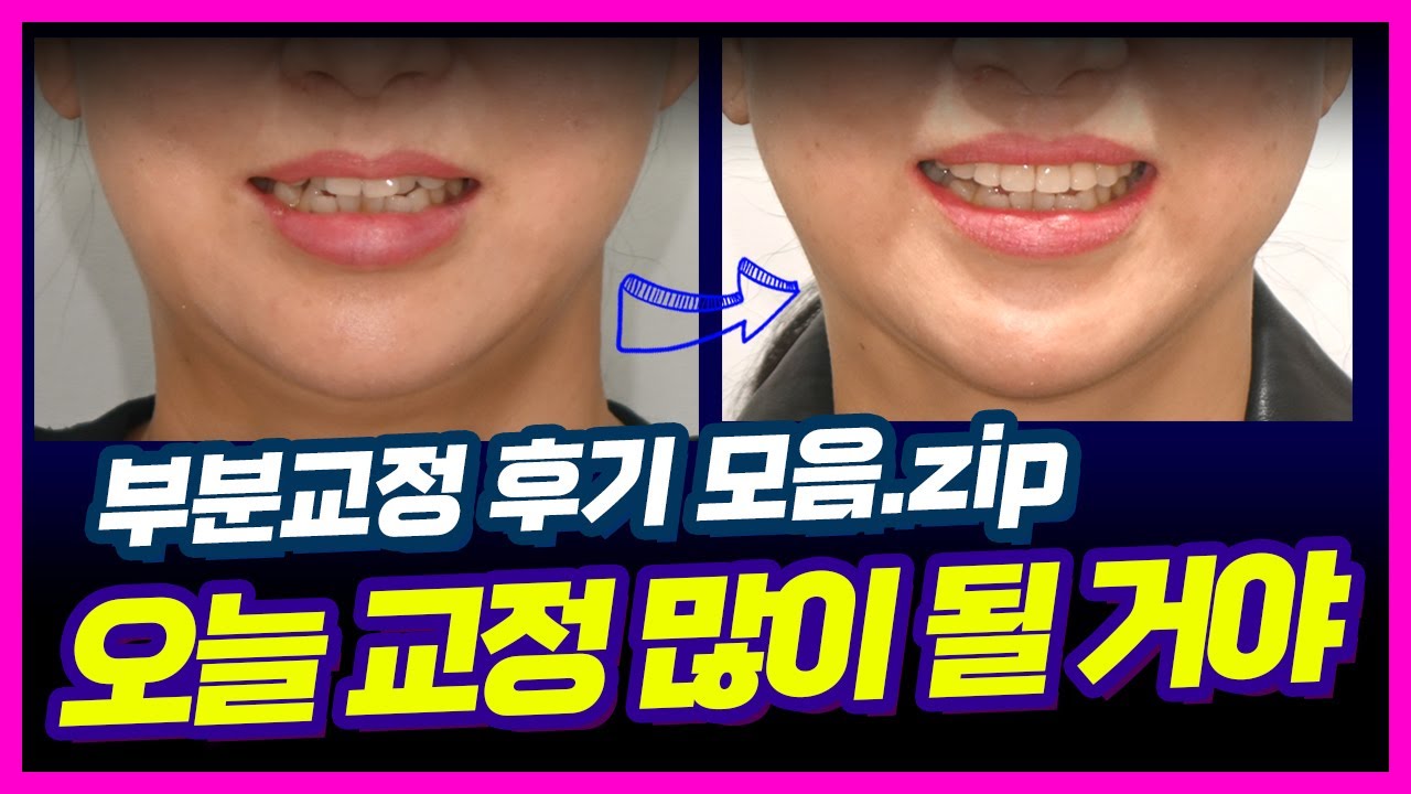 멸시 받아 억울했지만, 반전 있는 놀라운 부분교정 케이스 (#부분교정 #앞니교정 #덧니교정 #턱관절장애 #dentist #교정전문의 #교정전후