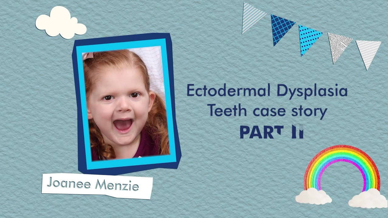 Ectodermal Dysplasia Teeth | Joanee's Story Part II