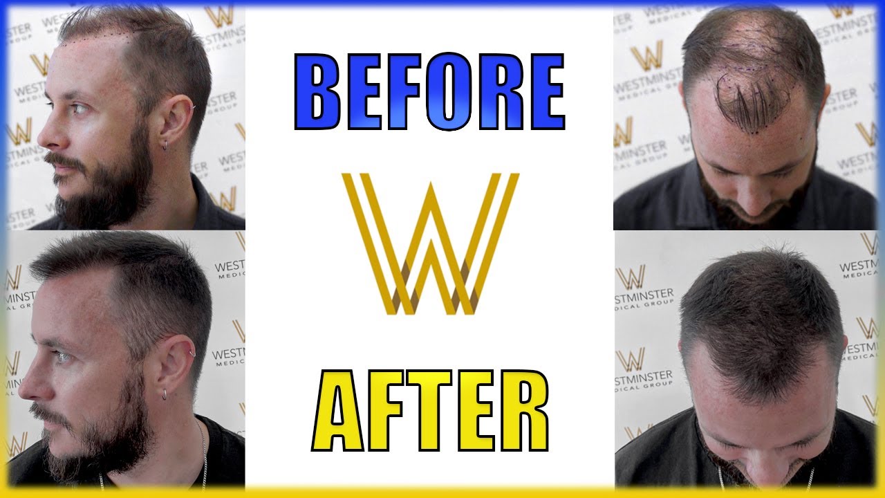 Chris' 12 month FUE Hair Transplant Transformation | London | Westminster Medical Group