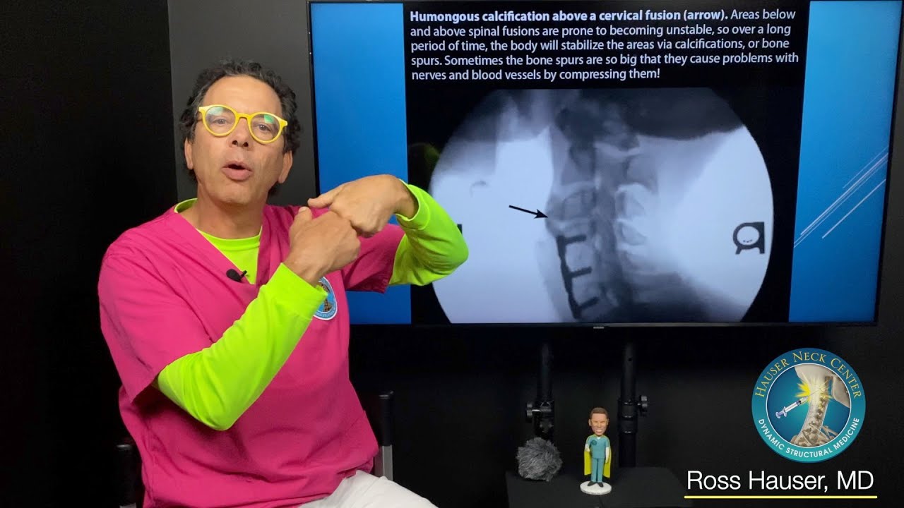 Adjacent segment disease- Can Prolotherapy help or is another fusion always necessary?