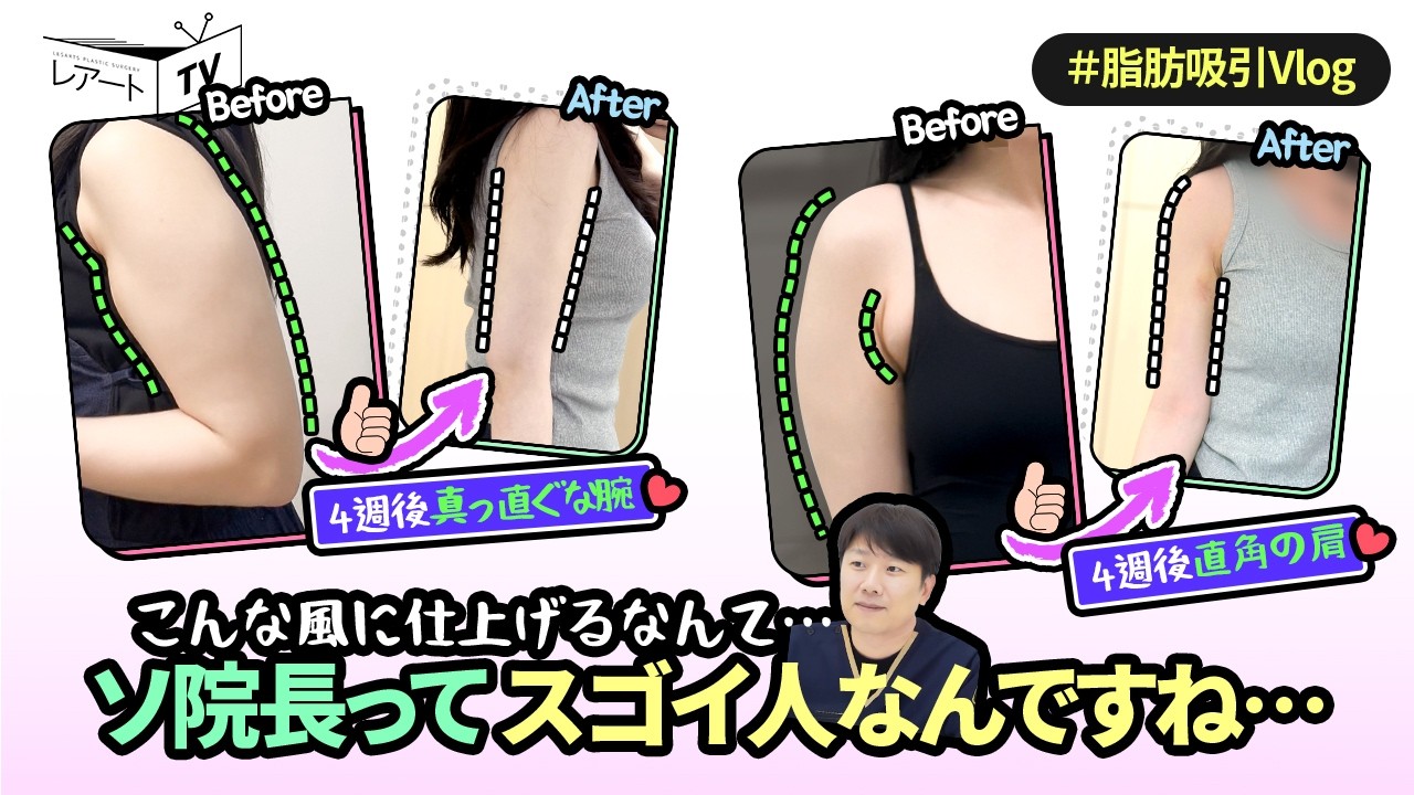 【二の腕の脂肪吸引】４週間での痣・腫れの変化😍【レアート整形外科】