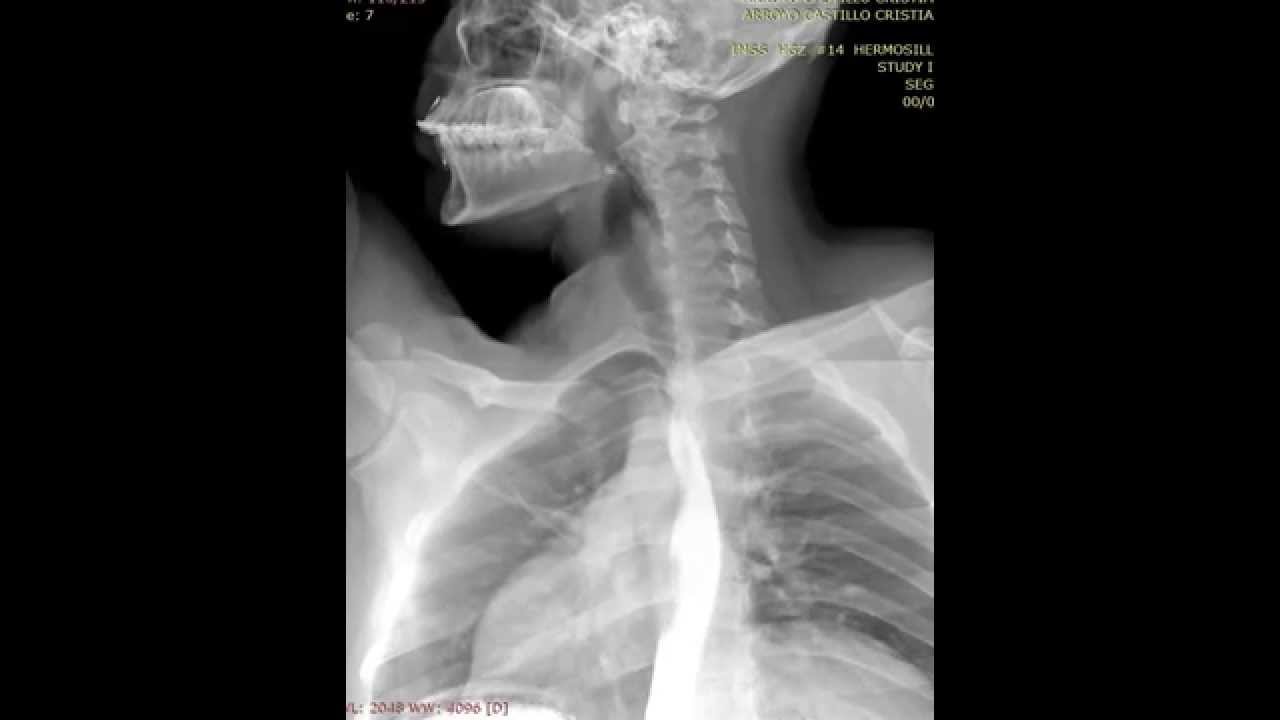 Radiograf&iacute;a esof&aacute;gica, tiempo real.