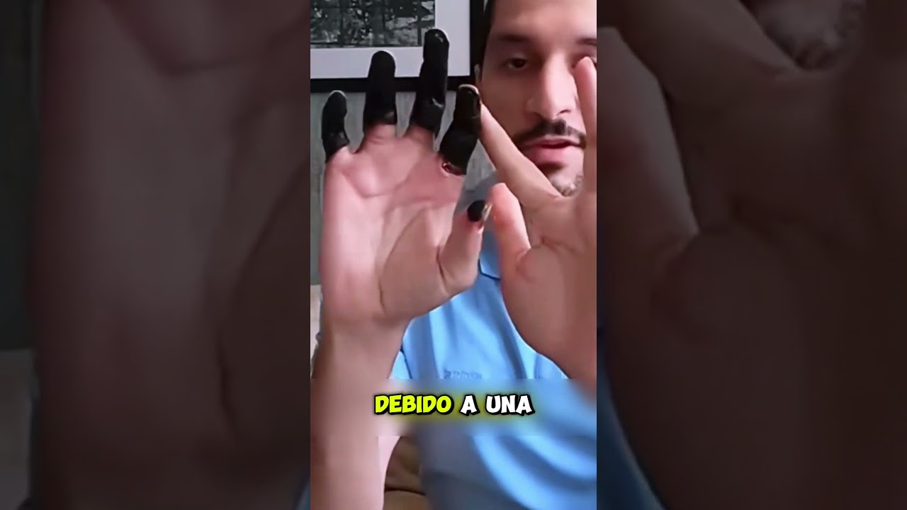 &iquest;Por Qu&eacute; Se Puso Negra Su Mano? &iexcl;La Impactante Verdad Sobre la Congelaci&oacute;n!