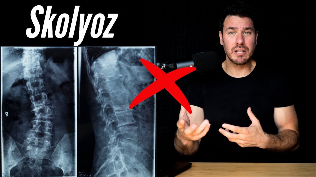 Skolyoz için yapılmaması gerekenler !!!