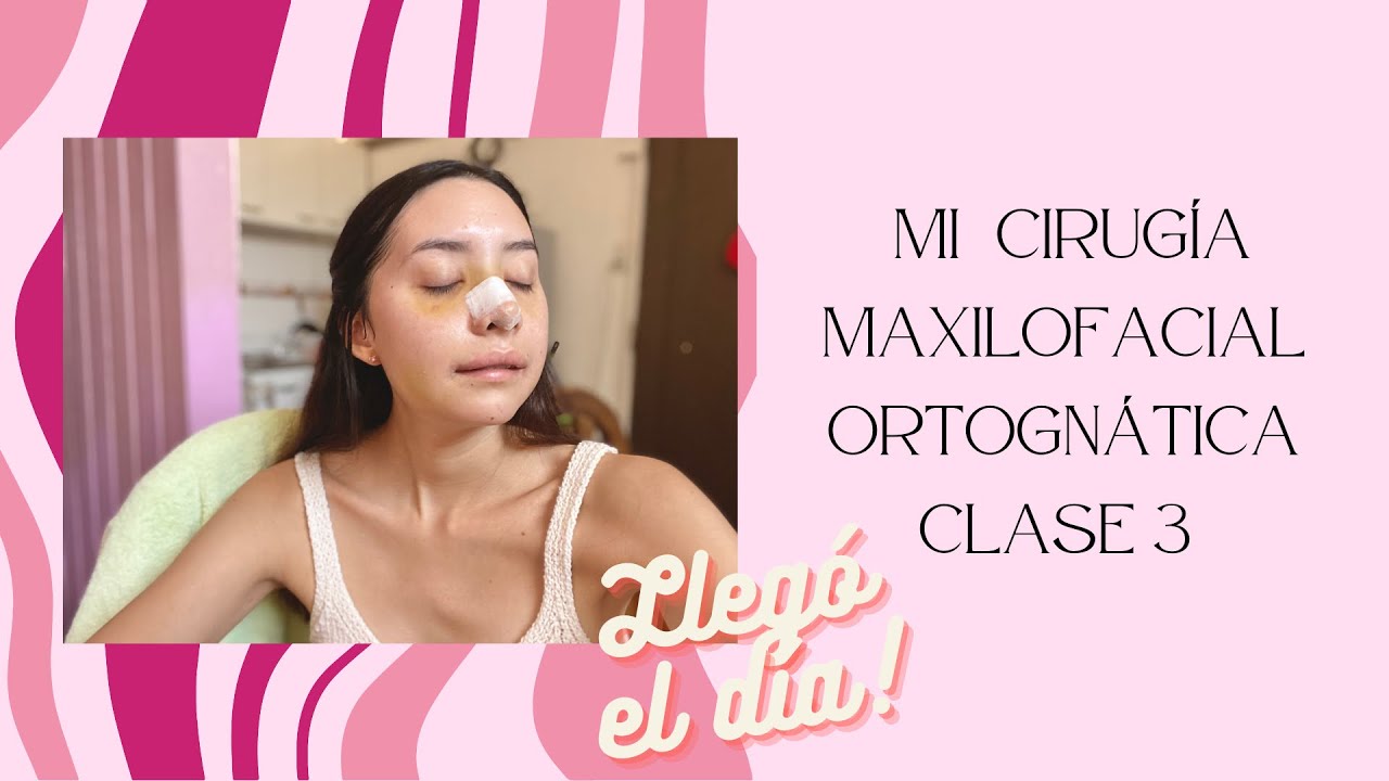 Cirugía Maxilofacial Ortognática Clase 3 | Chile | Euge Villaverde