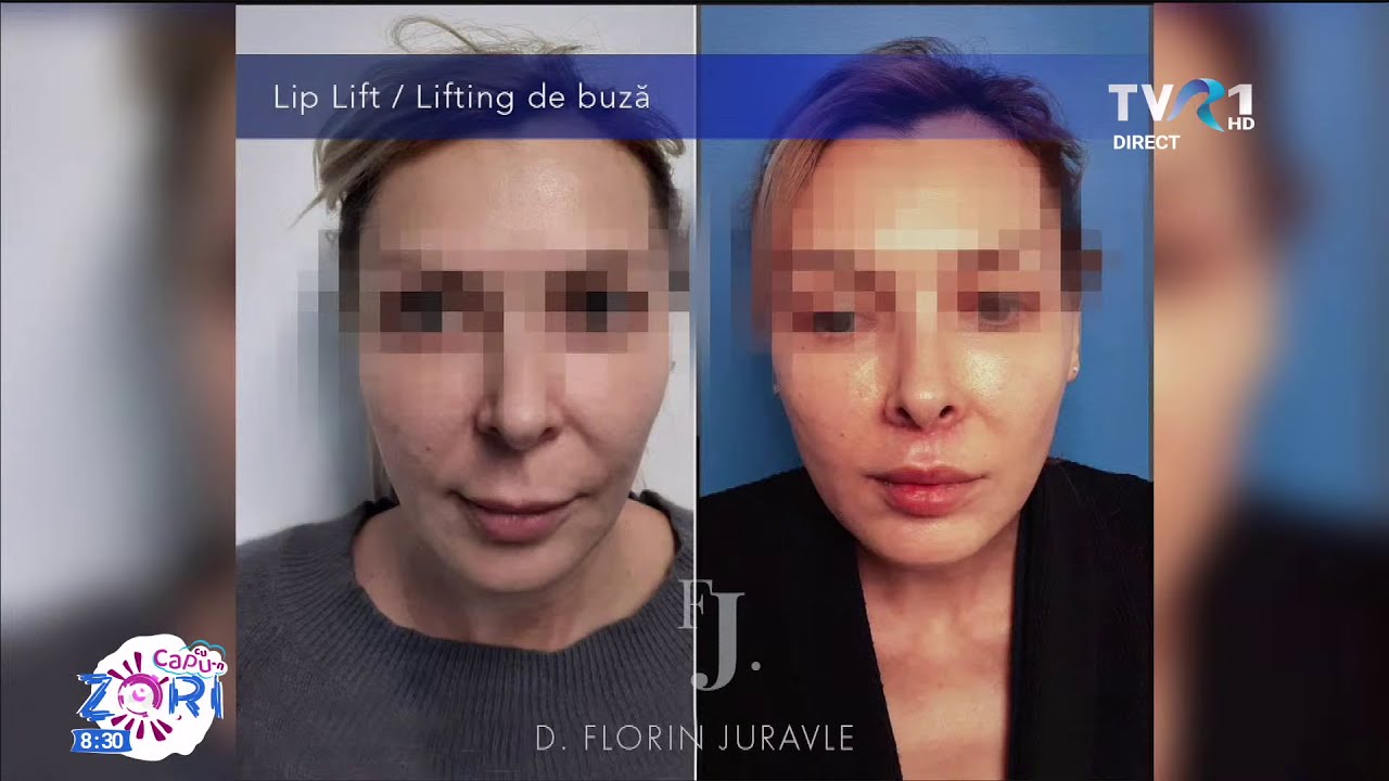 Dr. Florin Juravle, noile trenduri in estetica medicala: liplift si alte proceduri de infrumusetare