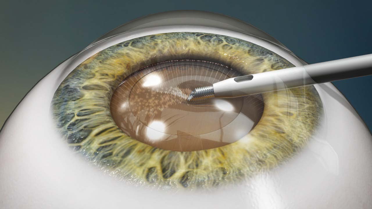 Eliminate the Need for Glasses with Refractive Lens Exchange.
