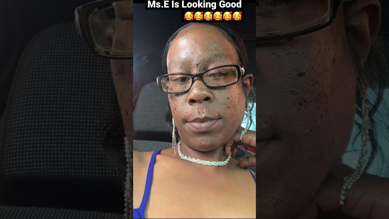Our Girl Ms.E Is Looking Good 🥰🥰🥰❤️❤️❤️ #acne #extraction #mychannel